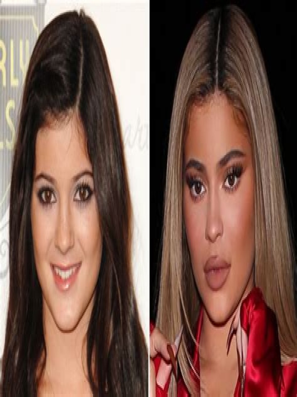 Kylie Jenner Is No Stranger to Plastic Surgery: Her Transformation Before and After Lip Fillers